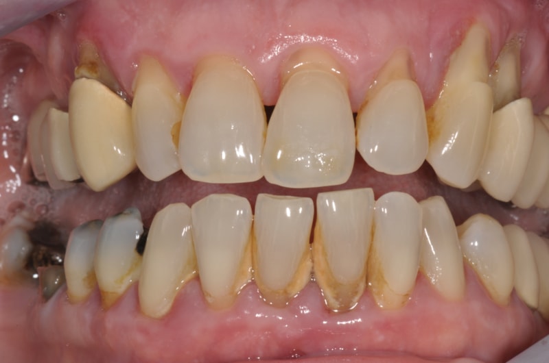 massive Parodontitis insbesondere im Oberkiefer mit lockeren, nicht mehr zu erhaltenden Zähnen